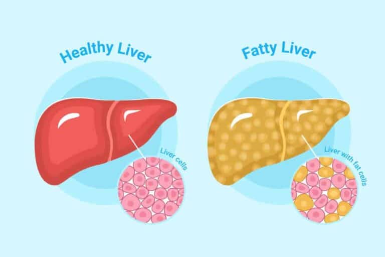 Healthy Liver vs Fatty Liver