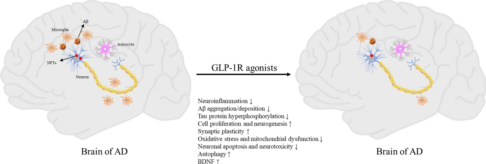 GLP-1 and Alzheimer's Dementia
